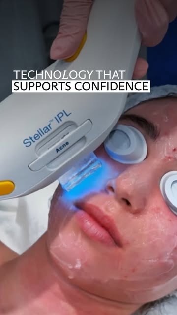 #Lumenis Reel by @lumenis (verified account) - Skin confidence starts here.

Stellar M22 supports clinics around the world with safe, effective acne treatment, designed with patient comfort and cli