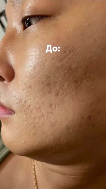 #уходзакожей Reel by @kristinakimy - Бустеры от @vtcosmetics_cis 🙌🏻

- Reti-A Reedle Shot 100
- VT Collagen Reedle Shot 100
- VT Vita-Light Reedle Shot 100

#уходзакожей #корейскаякосме