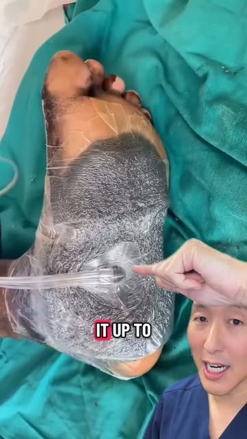 #Liz Wound Vac Adventure Reel by @tonyyounmd (verified account) - The VAC is one of the biggest advances in wound care over the past 25 years. Here is what it does!
.
#vac #vacsponge #negativepressurewoundtherapy