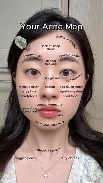 #Acne Reel by @heylina2484 - Acne shows up in different areas for different reasons. If you want to clear it, figuring out your acne trigger is the first step!
#acne #acnetreatme