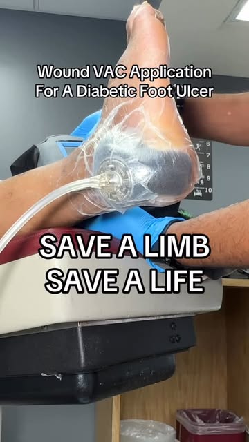 #Liz Wound Vac Adventure Reel by @dcfootdoctor - Wound VAC Application #podiatry #woundcare #woundvac #savealimbsavealife