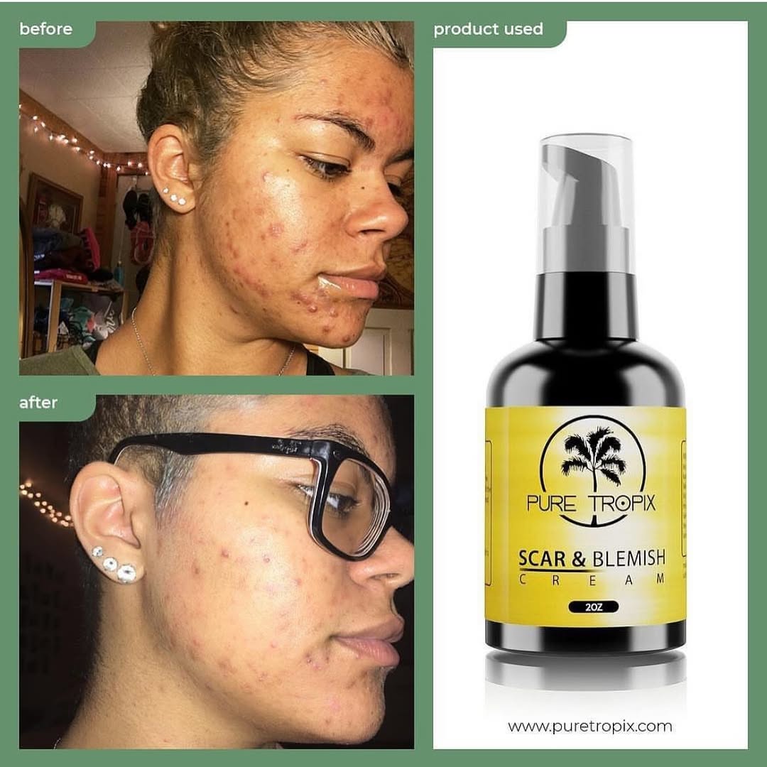Scars take a long time to heal, and can be bothersome if they’re in noticeable areas. In fact, if left untreated, they may never fully go away. However, with our Scar & Blemish and a little bit of pat