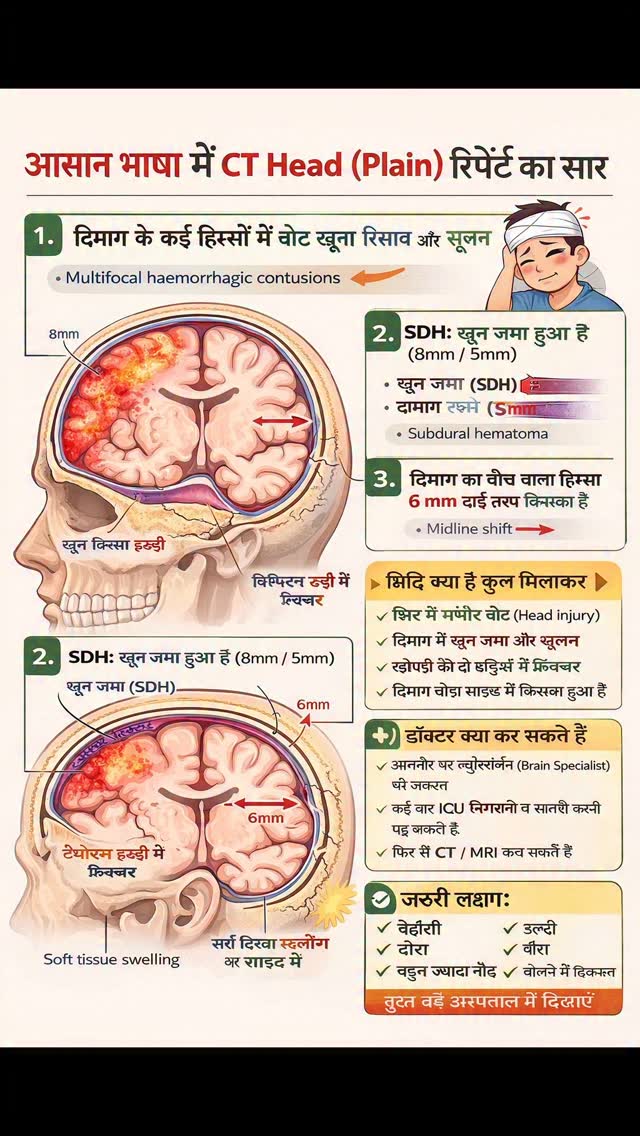 Multifocal haemorrhagic contusion with edema दिमाग के फ्रंटल और टेम्पो-पैरिएटल हिस्सों में कई जगह चोट के साथ खून का रिसाव (bleeding) और सूजन है। SDH (Subdural Hematoma) दिमाग की झिल्ली के नीचे खून जमा