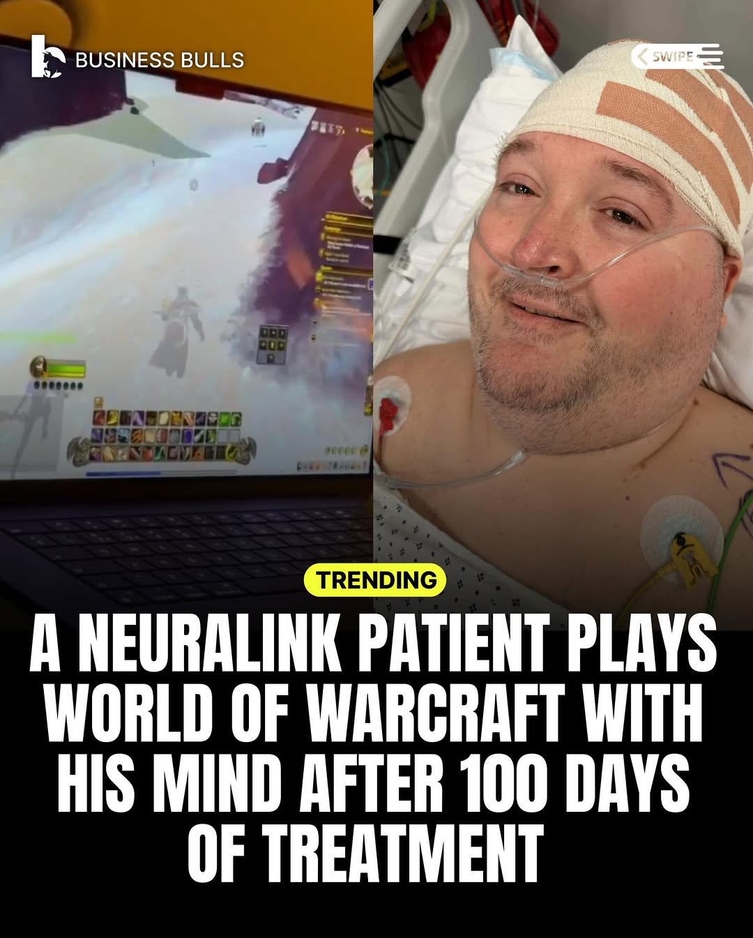 Neuralink patient Jon L. Noble has completed 100 days with the N1 implant, showing rapid progress in brain-computer technology. He now uses a MacBook entirely with his thoughts, moving beyond simple c